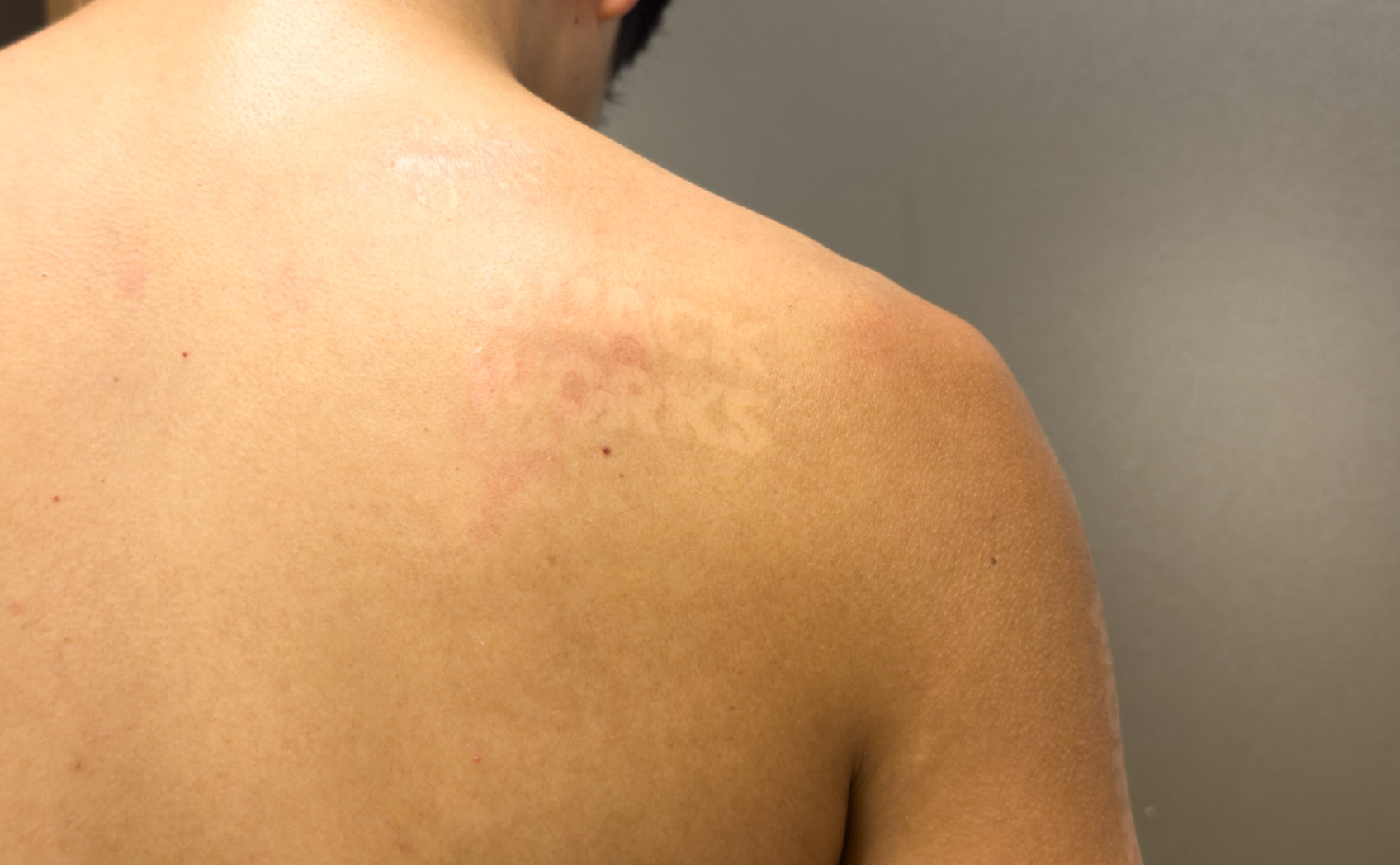 肌にカッティングシートは貼れるのか。そして日焼け跡はできるのかの実験